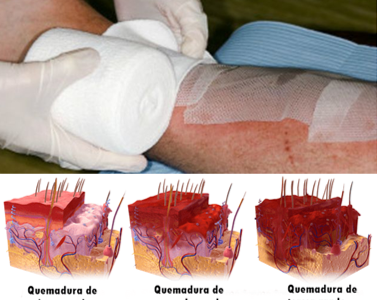 Cuidado de Enfermería en Unidad de Quemados